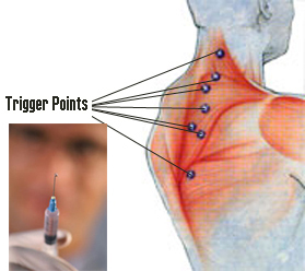 Trigger Point Injection of Local Anaesthetic