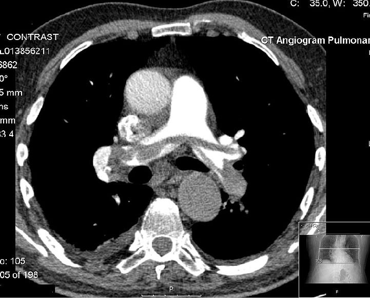CT Pulmonary Angiogram