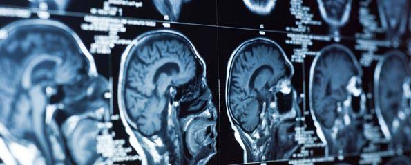 Brain cancer: Primitive neuroectodermal tumours (PNET)