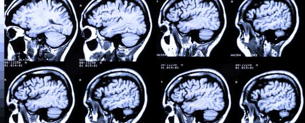 Brain scans may aid in diagnosis of autism
