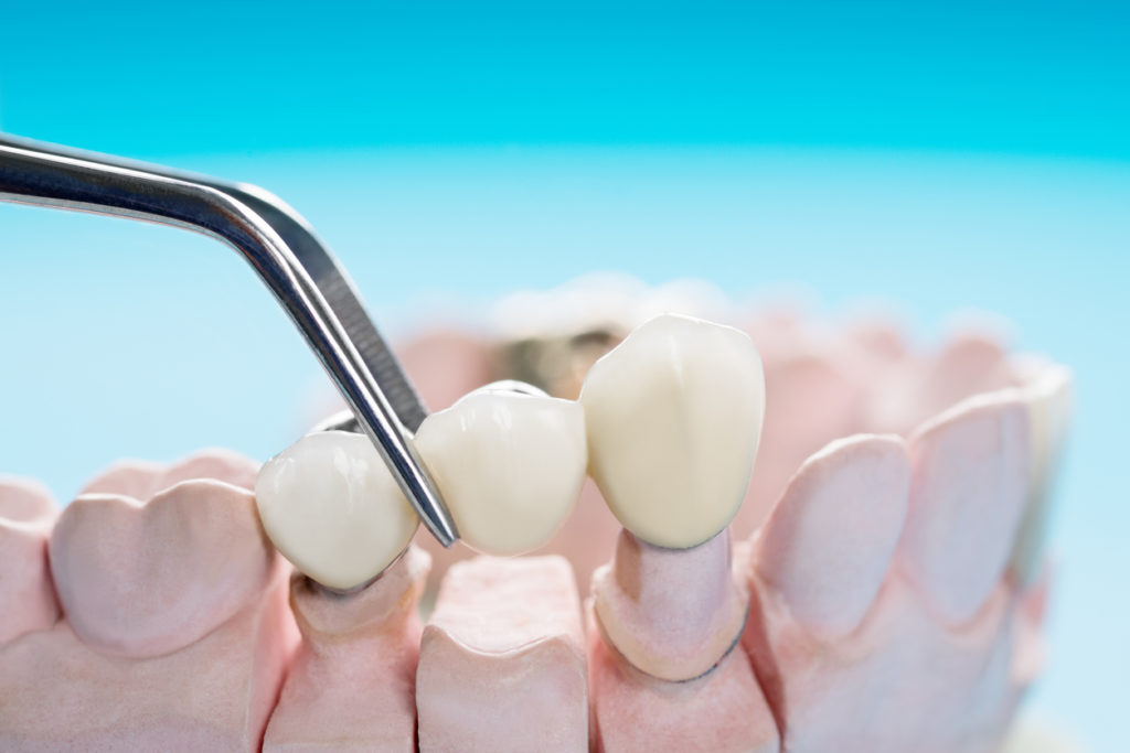 All You Need to Know About Dental Bridges