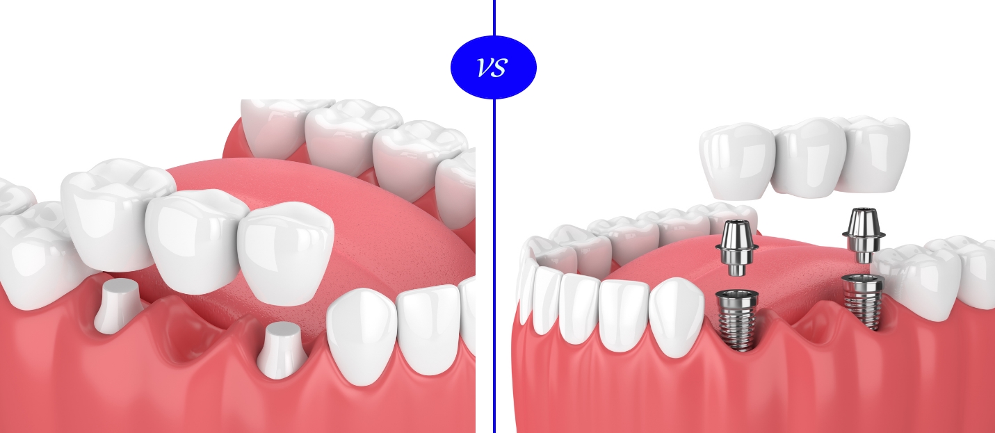 Dental Implants Versus Crown And Bridge Healthengine Blog