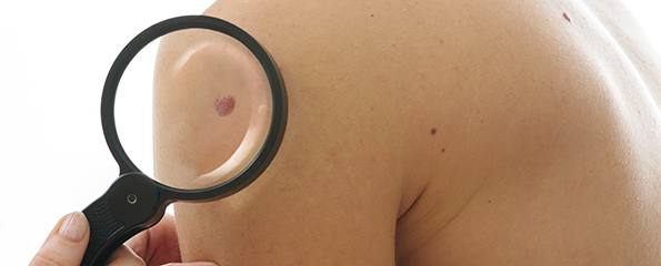 Melanoma prevention and skin checks: Dr Andrew Dean