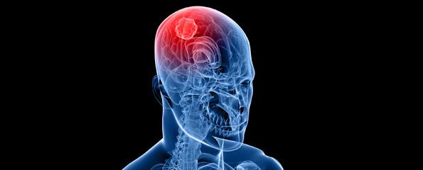Brain cancer: Glioblastoma multiforme of the brain