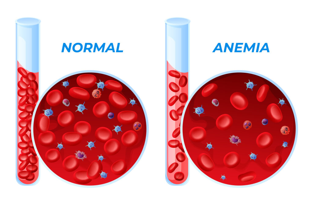 Anaemia During Pregnancy: Types, Causes, and Treatments