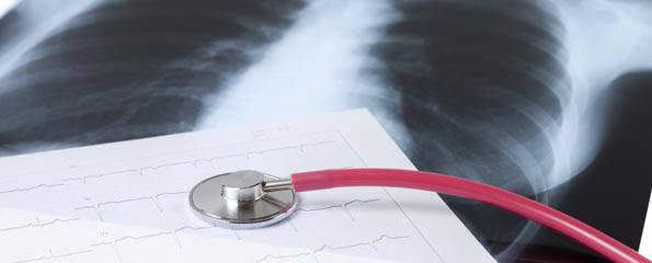 Acute respiratory distress syndrome (ARDS; acute alveolar injury; traumatic wet lungs)