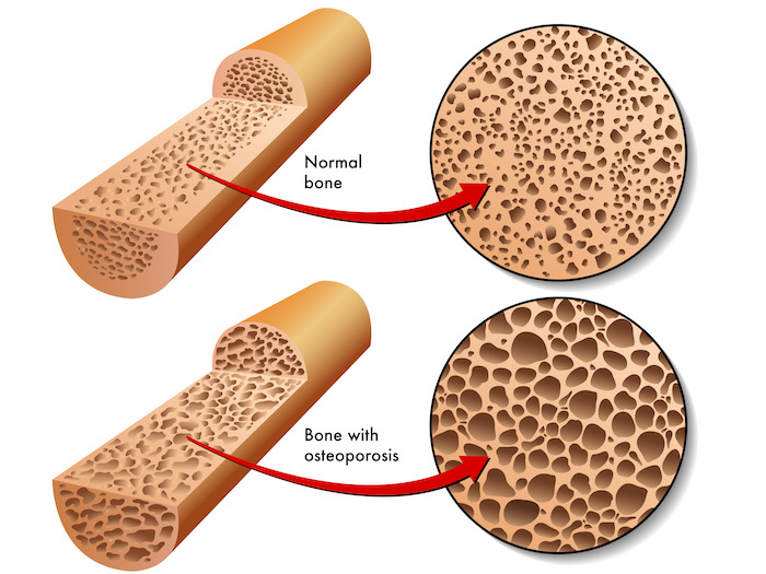 Osteoporosis - An enlarged comparison of a normal bone verses a bone with osteoporosis. 