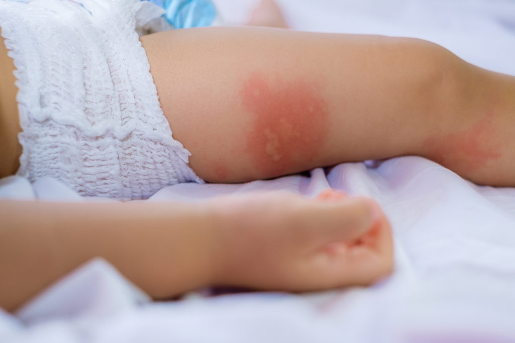 Serious allergic reaction? 11 ways of knowing if you’re having one