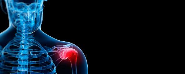 Frozen shoulder (adhesive capsulitis)