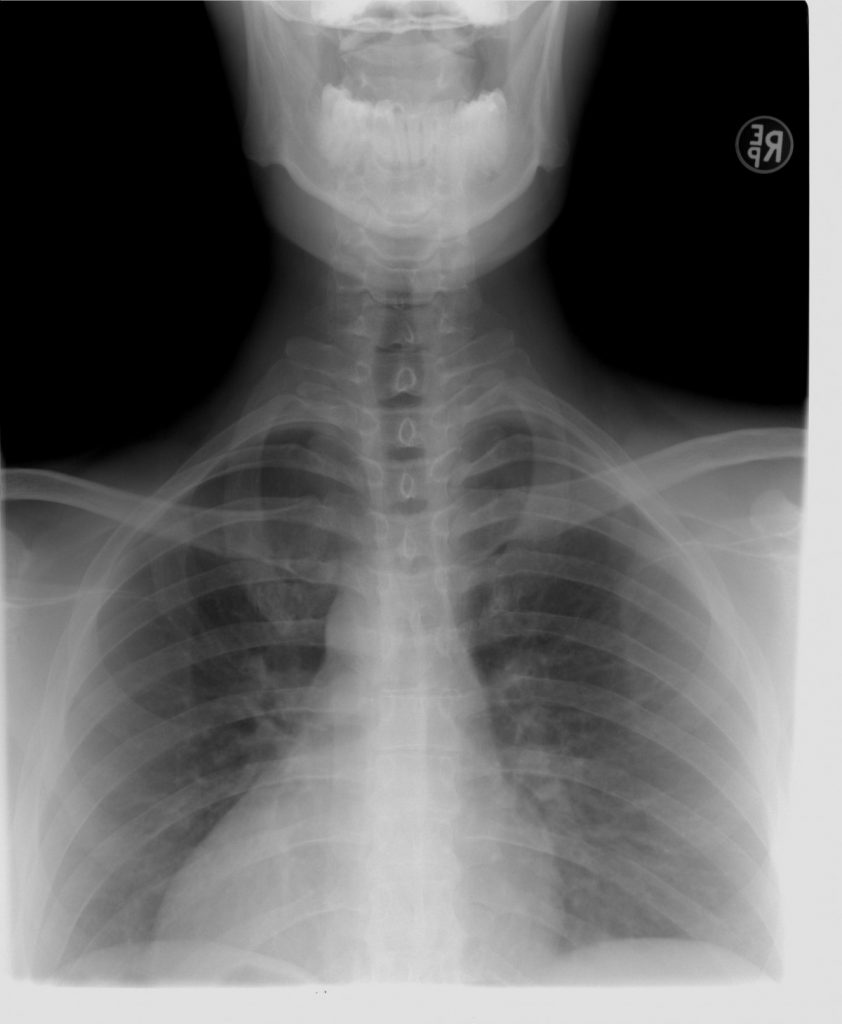 Lung Ct Scan Without Contrast