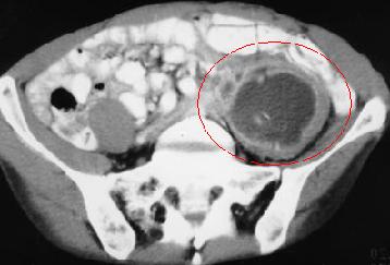 Psoas abscess