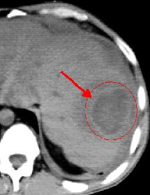 Visceral abscess