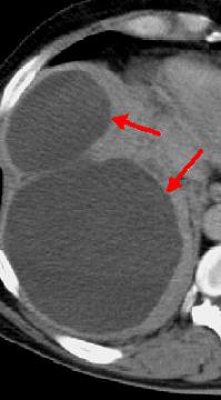 Sub-phrenic abscess