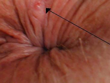 Anorectal abscess