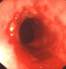 Inflamed oesophagus due to GORD picture