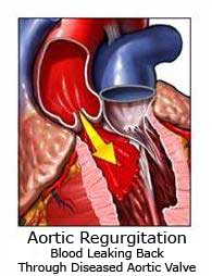 Aortic regurgitation image