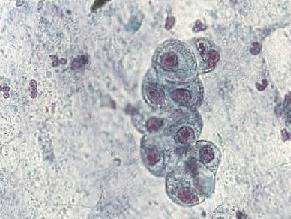 Haemoptysis