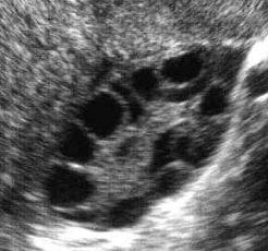 normal vs polycystic ovaries ultrasound