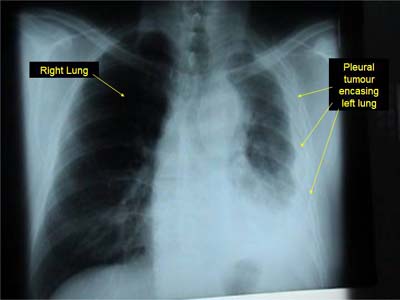 Malignant mesothelioma: x-ray