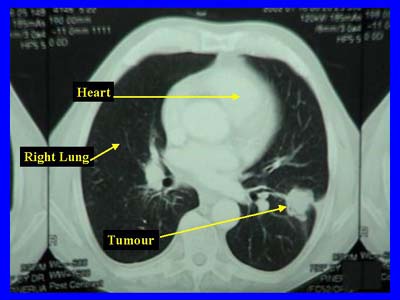 Small Cell Carcinoma of the Lung