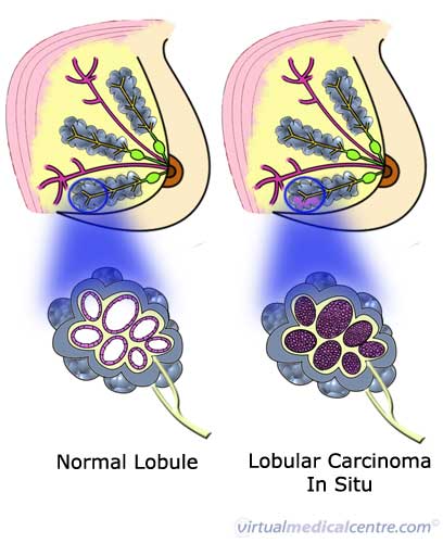 Lobular carcinoma of the breast (in situ)