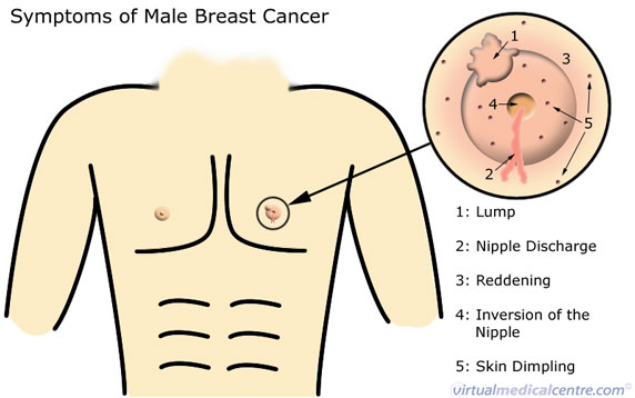 Breast cancer Male breast carcinoma Healthengine Blog