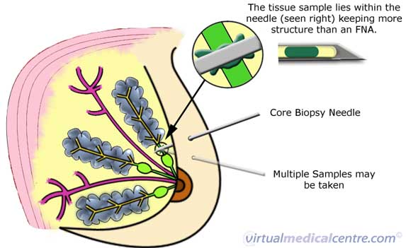 Core biopsy