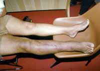 Deep Vein Thrombosis (Deep Venous Thrombosis, DVT)