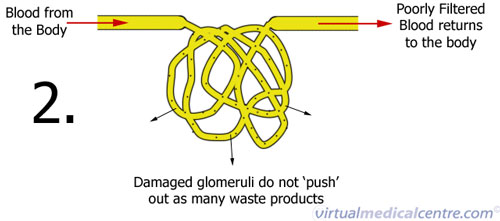 Kidney Disease - Chronic