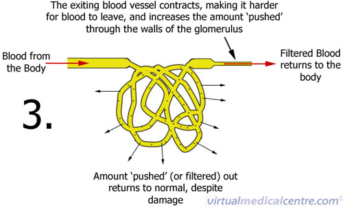 Kidney Disease - Chronic