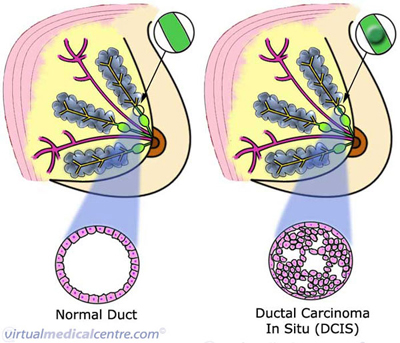 Ductal Carcinoma of the Breast (In situ)