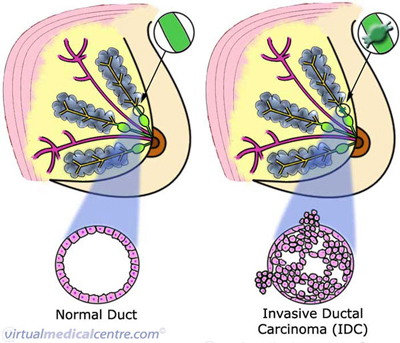 Ductal carcinoma of the breast (invasive)