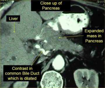 Expanded mass in pancreas image