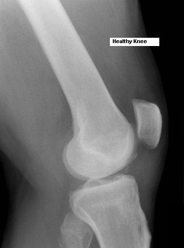 saddle joint xray