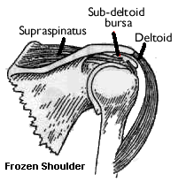 Frozen Shoulder