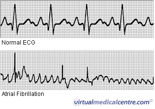 Atrial fibrillation ECG image