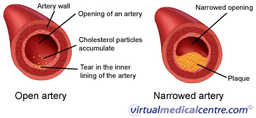 Arterial plaque