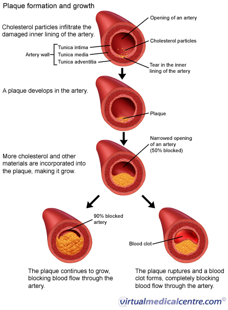 Plaque formation