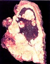 Adenocarcinoma of the Lung cancer