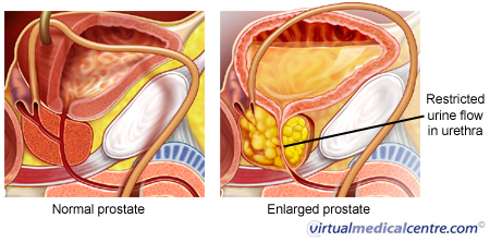 Enlarged prostate restricting urine flow