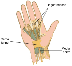 Carpal tunnel syndrome