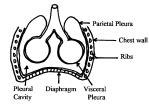 Pneumothorax