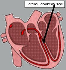 Heart block picture