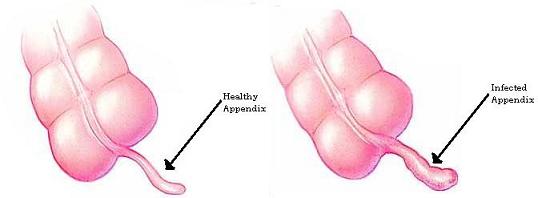 Appendicitis image