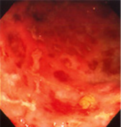 Inflammatory bowel disease picture