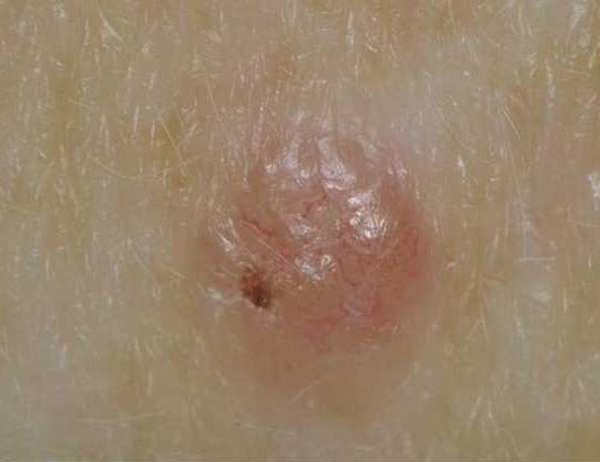 Basal Cell Carcinoma of the Skin