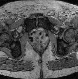 Figure 3b: Seeded prostate. The image of a prostate after the seeding procedure, where radioactive seeds are seen in the prostate gland. 