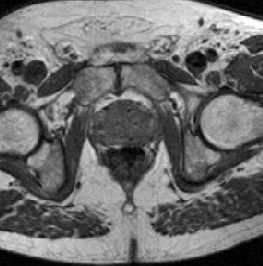 Figure 3a: Unseeded prostate. The image of a prostate before implantation of radioactive seeds.