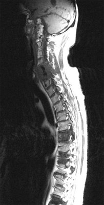 Metastases of the Spinal Cord