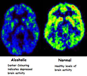 Brain activity: normal vs alcoholic's brain